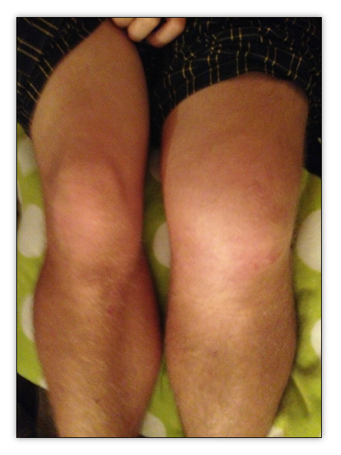 ACL Swelling